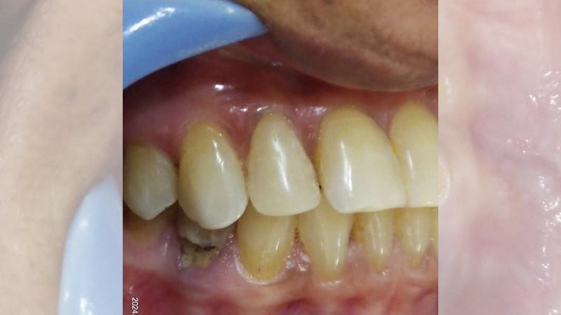 Fracture Tooth 1