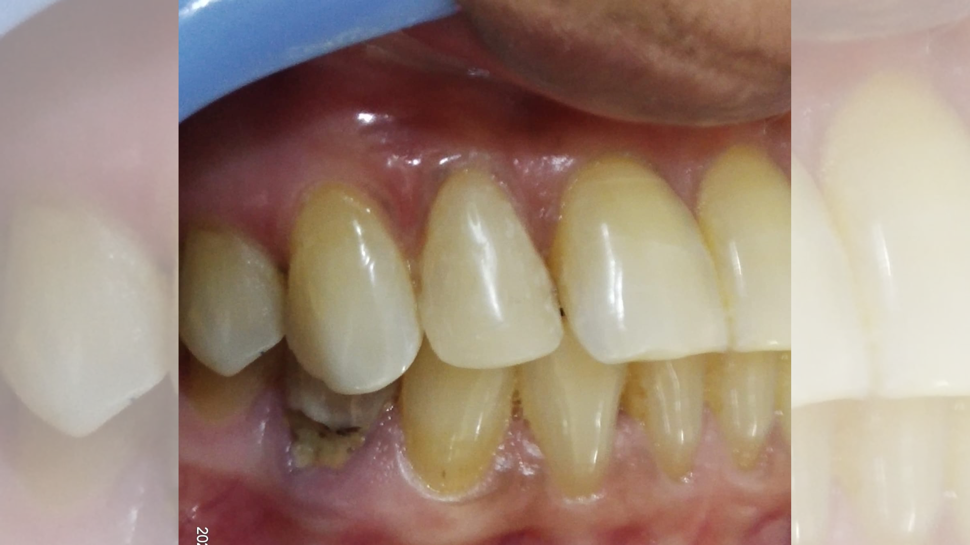 Fracture Tooth 2
