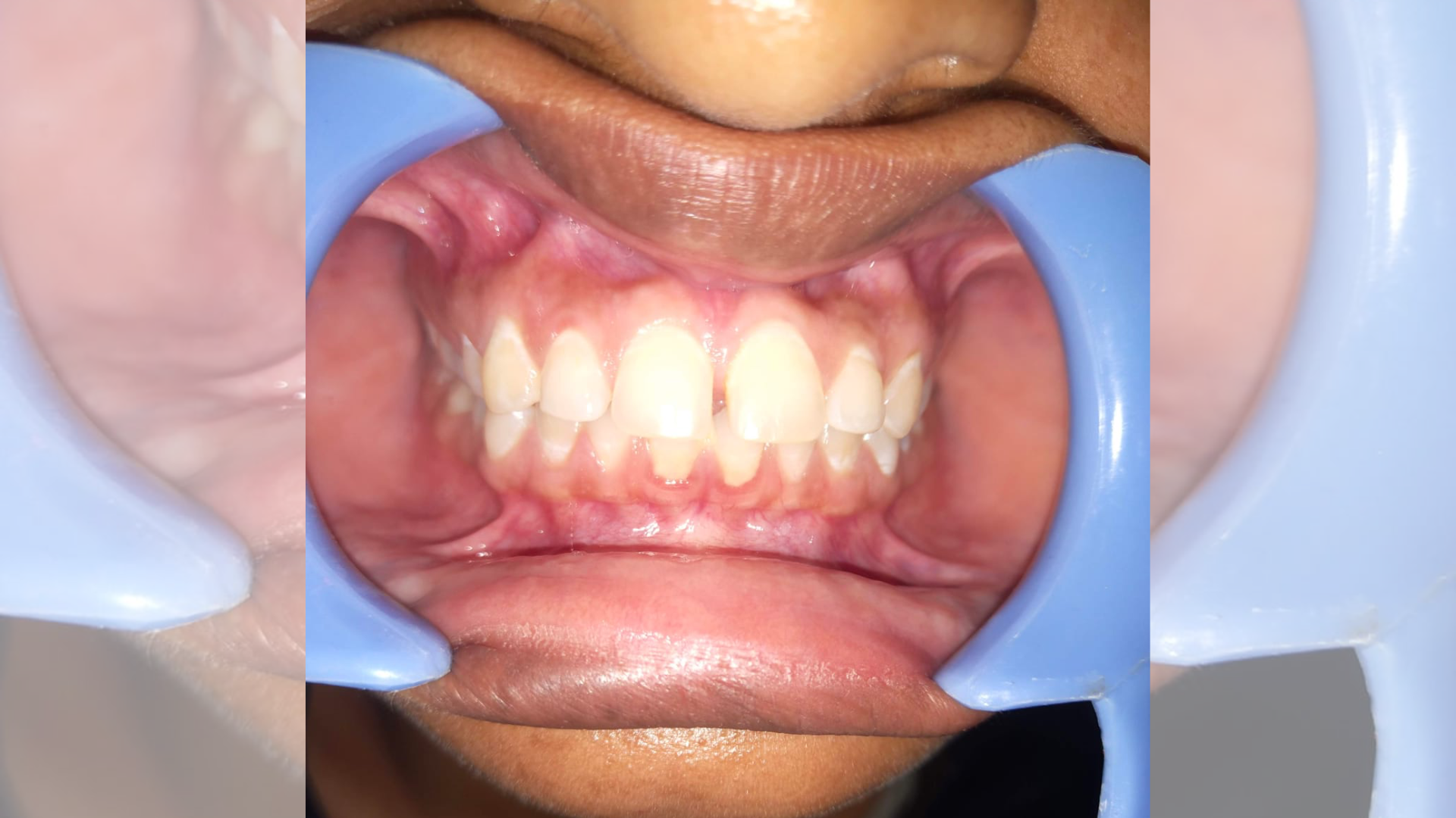 Diastema Closure 3